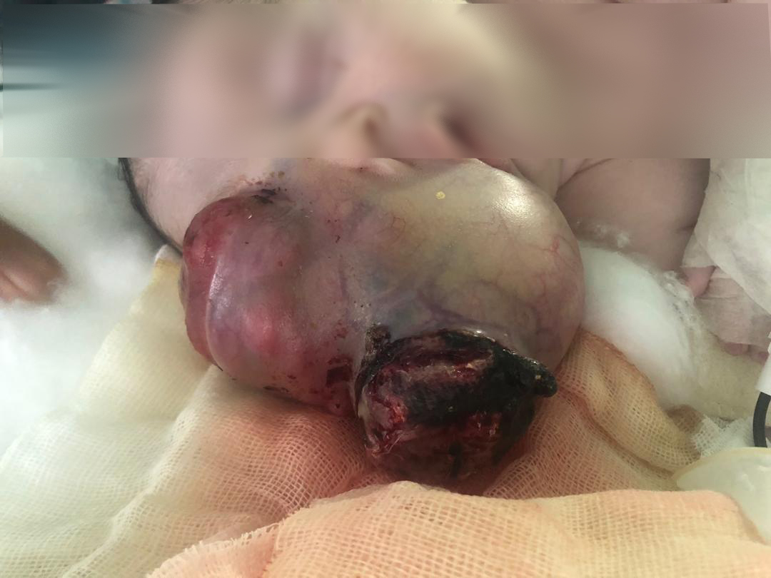 عمل جراحی نادر و موفقیت آمیز تخلیه تومور بزرگ از صورت نوزاد